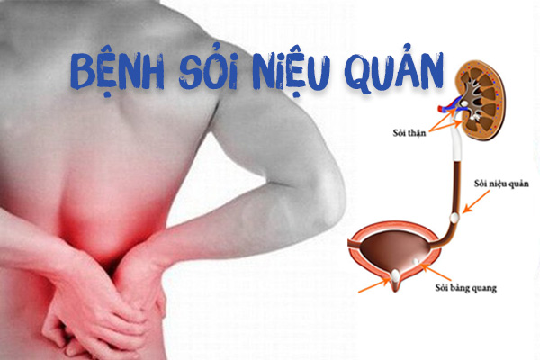 Người bệnh có thể cảm thấy đau ở bụng dưới hoặc bên sườn, đây là vùng lưng ngay dưới xương sườn